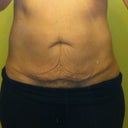 Front Tummy Pre Op