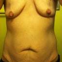 Pre Op