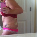 Post op day 3, side, pardon how hunched I am. I can't stand straight up for the life of me!