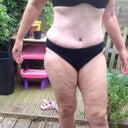 23 days post op - some swelling still