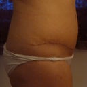 The scar on the side. Amazing profile when you look from the side and see no bulge!! :))))