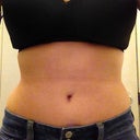 Front View at 5 Weeks PO - Still pretty swollen