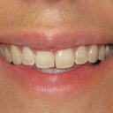 Lips 4 years after Restylane, upper lip still deformed.