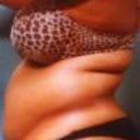Before Smart Lipo