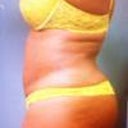1 Month Post-Op and it only gets better!!