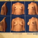 The 3D image offered at the consult. Top photo is current, bottom is what I may look like post-op.
