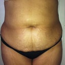 1 week before surgery