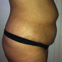 1 week before surgery