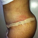 day 5 post op