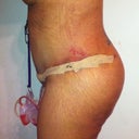 day 8 post op
