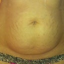 My belly, def need a TT, but really want a low bikini scar