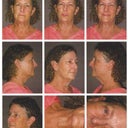Photos taken the day of my facelift