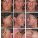 Nine weeks after the facelift.