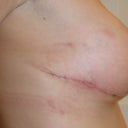 Incision extends 3-4" too far and beyond arm pit.  Shows in bathing suits.