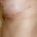 On left side incision extends beyond what is customary practice, very visible.