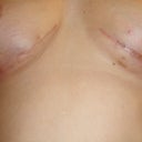 This shows scars are not hidden in breast fold.