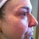 Pre fraxel-no makeup