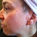 Pre fraxel-no makeup