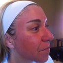 Treatment 1-post fraxel 2 hours