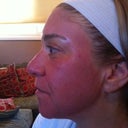 Treatment 1-post fraxel 2 hours