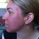 Treatment 1-post fraxel day 2