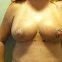 Post Op Day 10