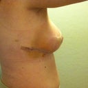 Post Op Day 10