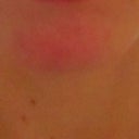 Chin before- Notice the redness