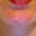 Chin after- notice the acne/bumps