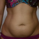 1 day before procedure