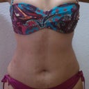 10 days post procedure