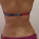 10 days post procedure