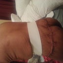 I don't know if this is swelling or excess meat idk....