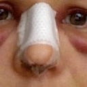 First Day after surgery