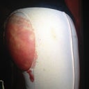 1 day post op!!