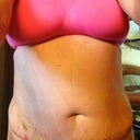 8 days post op