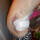 3 days post op
