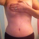 Day 10 PO - Nighttime pic. Even taken at the end of the day with swelling present, I don't look too bad.