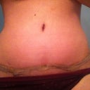 Day 10 PO - Nighttime pic close up of belly button and steristrips.