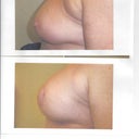 Implants