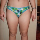 Before SmartLipo