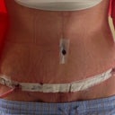 3 days post op