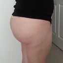 5 months post op