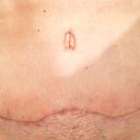 4 weeks scar after 2 weeks biocorneum scar treatment