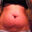 Pre-Op Photo 1