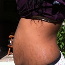 day before surgery...left view