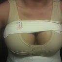 Well, hello ladies! 2 days post-op, with 560 CC's