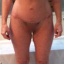 Almost 4 1/2 months after arm/breast surgery and 4 months after LBL.