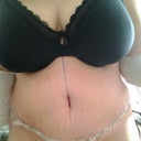 This is day 2 post op :)