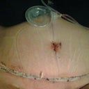 This is day 4 post op, laying down.  Just took off my binder for my first shower.
